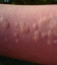 Elpošanas ceļu alerģijas bērniem Elpceļu alerģijas ārstēšana