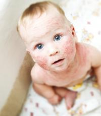 Atopisk dermatit hos spädbarn: foton, symtom, orsaker och behandling