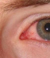 ما هي عواقب إعتام عدسة العين إذا لم يتم إجراء الجراحة؟
